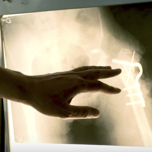 osteoporosis-one-health-clinic-Michigan-Orthopedic-Center-Lansing-Okemos-MI